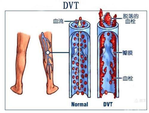 腿腫莫忘了他1.jpg