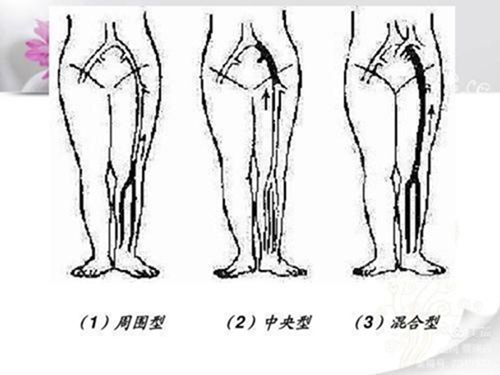 腿腫莫忘了他3.jpg